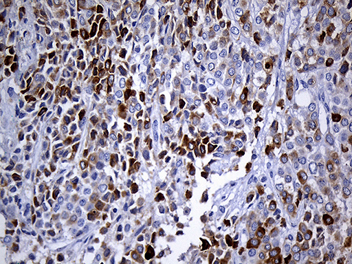 TFF3 / Trefoil Factor 3 Antibody - Immunohistochemical staining of paraffin-embedded Adenocarcinoma of Human breast tissue tissue using anti-TFF3 mouse monoclonal antibody. (Heat-induced epitope retrieval by 1mM EDTA in 10mM Tris buffer. (pH8.5) at 120°C for 3 min. (1:500)