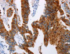 TFF3 / Trefoil Factor 3 Antibody - Immunohistochemistry of paraffin-embedded Human colon cancer using TFF3 Polyclonal Antibody at dilution of 1:50.