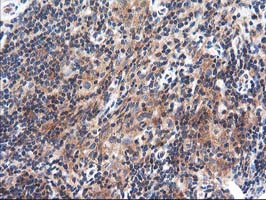 TFG Antibody - IHC of paraffin-embedded Human lymphoma tissue using anti-TFG mouse monoclonal antibody.