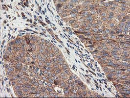 TFG Antibody - IHC of paraffin-embedded Carcinoma of Human bladder tissue using anti-TFG mouse monoclonal antibody.
