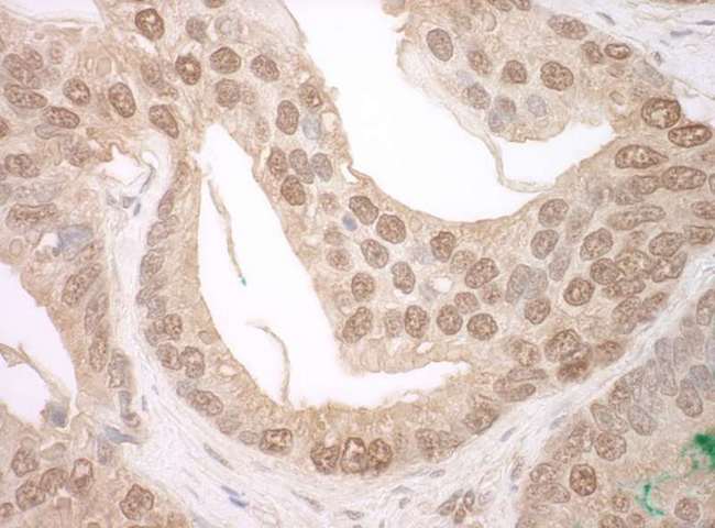 TFIP11 Antibody - Detection of Human TFIP11 by Immunohistochemistry. Sample: FFPE section of human prostate carcinoma. Antibody: Affinity purified rabbit anti-TFIP11 used at a dilution of 1:250.