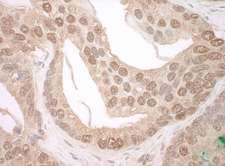 TFIP11 Antibody - Detection of Human TFIP11 by Immunohistochemistry. Sample: FFPE section of human prostate carcinoma. Antibody: Affinity purified rabbit anti-TFIP11 used at a dilution of 1:250.
