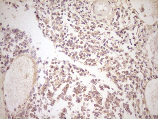 TFPI / LACI Antibody - IHC of paraffin-embedded Human thyroid tissue using anti-TFPI mouse monoclonal antibody. (Heat-induced epitope retrieval by 1 mM EDTA in 10mM Tris, pH8.5, 120°C for 3min).