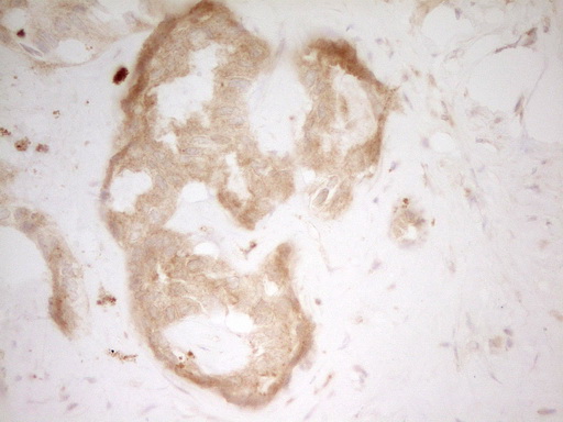 TFPI / LACI Antibody - IHC of paraffin-embedded Carcinoma of Human liver tissue using anti-TFPI mouse monoclonal antibody. (Heat-induced epitope retrieval by 1 mM EDTA in 10mM Tris, pH8.5, 120°C for 3min).