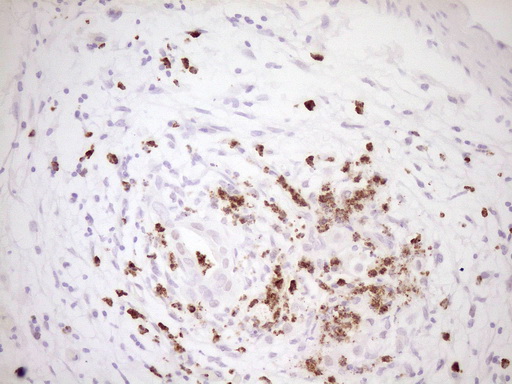 TFPI / LACI Antibody - Immunohistochemical staining of paraffin-embedded Carcinoma of Human pancreas tissue using anti-TFPI mouse monoclonal antibody. (Heat-induced epitope retrieval by 1 mM EDTA in 10mM Tris, pH8.5, 120C for 3min,