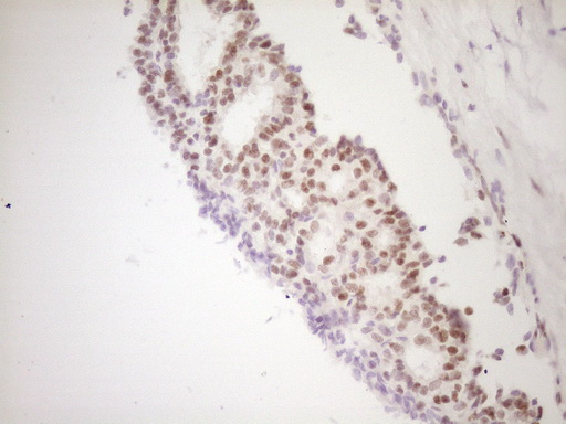 TFPI / LACI Antibody - Immunohistochemical staining of paraffin-embedded Adenocarcinoma of Human breast tissue using anti-TFPI mouse monoclonal antibody. (Heat-induced epitope retrieval by 1 mM EDTA in 10mM Tris, pH8.5, 120C for 3min,