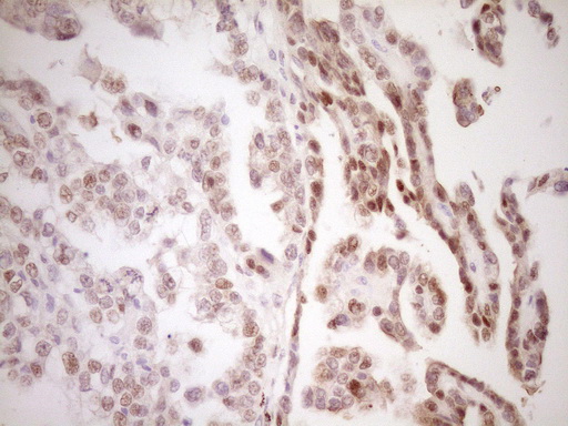TFPI / LACI Antibody - IHC of paraffin-embedded Adenocarcinoma of Human ovary tissue using anti-TFPI mouse monoclonal antibody. (Heat-induced epitope retrieval by 1 mM EDTA in 10mM Tris, pH8.5, 120°C for 3min).