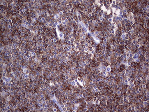 TFPI2 Antibody - Immunohistochemical staining of paraffin-embedded Human lymphoma tissue using anti-TFPI2 mouse monoclonal antibody. (Heat-induced epitope retrieval by 1 mM EDTA in 10mM Tris, pH8.5, 120C for 3min,