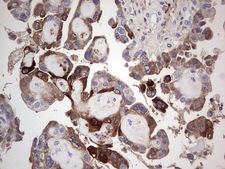 TFPI2 Antibody - Immunohistochemical staining of paraffin-embedded Adenocarcinoma of Human ovary tissue using anti-TFPI2 mouse monoclonal antibody. (Heat-induced epitope retrieval by 1 mM EDTA in 10mM Tris, pH8.5, 120C for 3min,