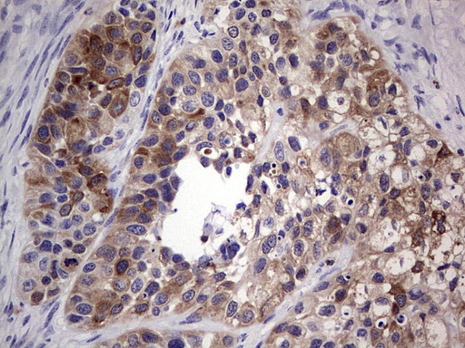 TFPI2 Antibody - Immunohistochemical staining of paraffin-embedded Carcinoma of Human kidney tissue using anti-TFPI2 mouse monoclonal antibody. (Heat-induced epitope retrieval by 1 mM EDTA in 10mM Tris, pH8.5, 120C for 3min,