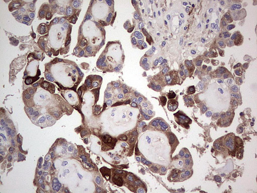 TFPI2 Antibody - IHC of paraffin-embedded Adenocarcinoma of Human ovary tissue using anti-TFPI2 mouse monoclonal antibody. (Heat-induced epitope retrieval by 1 mM EDTA in 10mM Tris, pH8.5, 120°C for 3min).