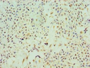 TFPI2 Antibody - Immunohistochemistry of paraffin-embedded human breast cancer using antibody at 1:100 dilution.