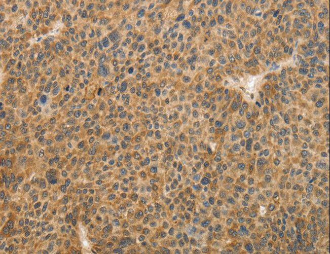 TFPI2 Antibody - Immunohistochemistry of paraffin-embedded Human lung cancer using TFPI2 Polyclonal Antibody at dilution of 1:30.