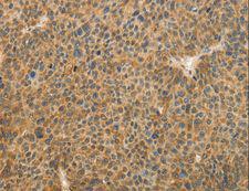 TFPI2 Antibody - Immunohistochemistry of paraffin-embedded Human lung cancer using TFPI2 Polyclonal Antibody at dilution of 1:30.