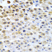 TFPI2 Antibody - Immunohistochemistry of paraffin-embedded human liver cancer tissue.