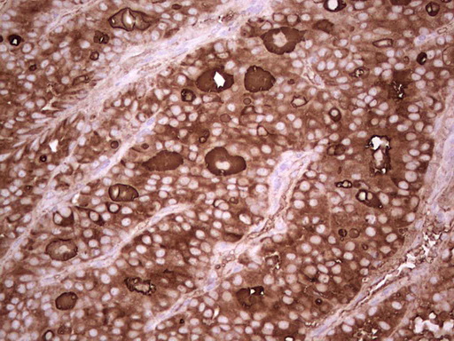 TG / Thyroglobulin Antibody - Immunohistochemical staining of paraffin-embedded Carcinoma of Human thyroid tissue using anti-TG mouse monoclonal antibody. (Heat-induced epitope retrieval by 1 mM EDTA in 10mM Tris, pH8.5, 120C for 3min,
