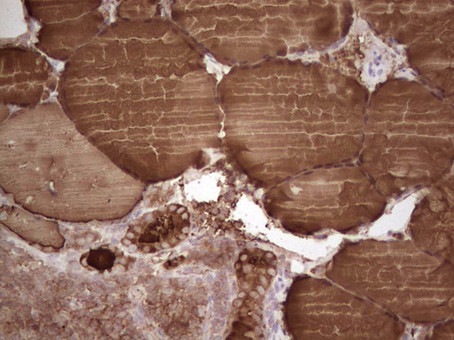 TG / Thyroglobulin Antibody - IHC of paraffin-embedded Human thyroid tissue using anti-TG mouse monoclonal antibody. (Heat-induced epitope retrieval by 1 mM EDTA in 10mM Tris, pH8.5, 120°C for 3min).