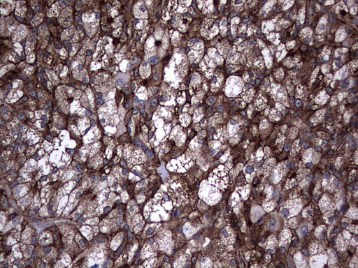 TG / Thyroglobulin Antibody - IHC of paraffin-embedded Carcinoma of Human thyroid tissue using anti-TG mouse monoclonal antibody. (Heat-induced epitope retrieval by 1 mM EDTA in 10mM Tris, pH8.5, 120°C for 3min).