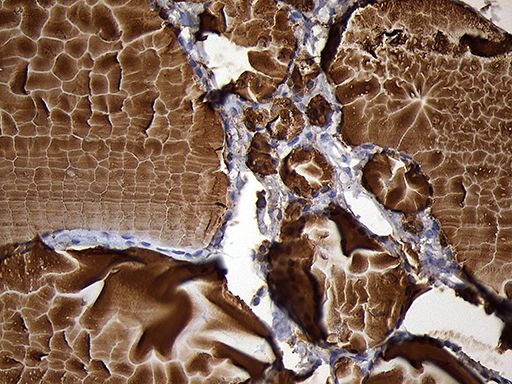 TG / Thyroglobulin Antibody - Immunohistochemical staining of paraffin-embedded Human thyroid tissue within the normal limits using anti-TG mouse monoclonal antibody. (Heat-induced epitope retrieval by 1mM EDTA in 10mM Tris buffer. (pH8.5) at 120°C for 3 min. (1:2000)