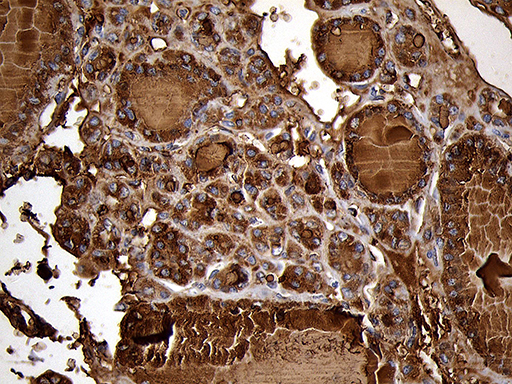 TG / Thyroglobulin Antibody - Immunohistochemical staining of paraffin-embedded Carcinoma of Human thyroid tissue using anti-TG mouse monoclonal antibody. (Heat-induced epitope retrieval by 1mM EDTA in 10mM Tris buffer. (pH8.5) at 120°C for 3 min. (1:2000)