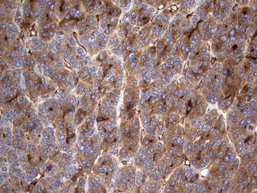 TG / Thyroglobulin Antibody - Immunohistochemical staining of paraffin-embedded Carcinoma of Human thyroid tissue using anti-TG mouse monoclonal antibody. (Heat-induced epitope retrieval by 1mM EDTA in 10mM Tris buffer. (pH8.5) at 120°C for 3 min. (1:150)