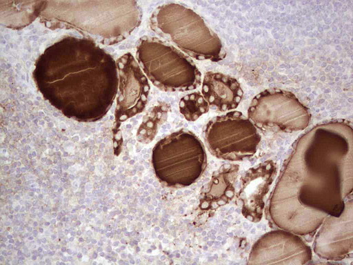 TG / Thyroglobulin Antibody - IHC of paraffin-embedded Human thyroid tissue using anti-TG mouse monoclonal antibody. (Heat-induced epitope retrieval by 1 mM EDTA in 10mM Tris, pH8.5, 120°C for 3min).