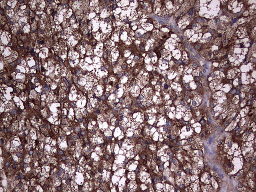 TG / Thyroglobulin Antibody - IHC of paraffin-embedded Carcinoma of Human thyroid tissue using anti-TG mouse monoclonal antibody. (Heat-induced epitope retrieval by 1 mM EDTA in 10mM Tris, pH8.5, 120°C for 3min).
