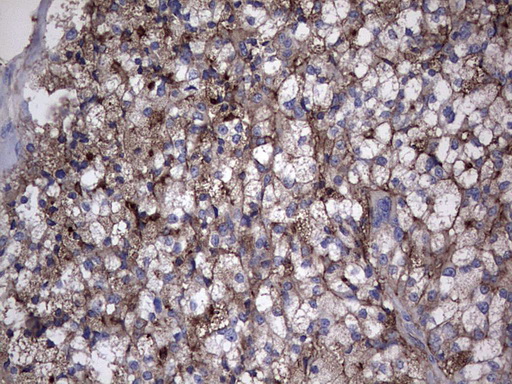 TG / Thyroglobulin Antibody - Immunohistochemical staining of paraffin-embedded Carcinoma of Human thyroid tissue using anti-TG mouse monoclonal antibody. (Heat-induced epitope retrieval by 1 mM EDTA in 10mM Tris, pH8.5, 120C for 3min,