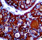 TG / Thyroglobulin Antibody - IHC of Thyroglobulin on FFPE Papillary Thyroid Carcinoma Tissue.