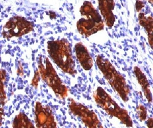 TG / Thyroglobulin Antibody - IHC staining of thyroid tissue with Thyroglobulin antibody (2H11, aka clone TBG04).