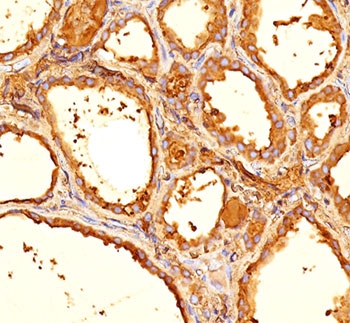 TG / Thyroglobulin Antibody - Thyroglobulin antibody 6E1 or TGB05 immunohistochemistry thyroid.  This image was taken for the unmodified form of this product. Other forms have not been tested.