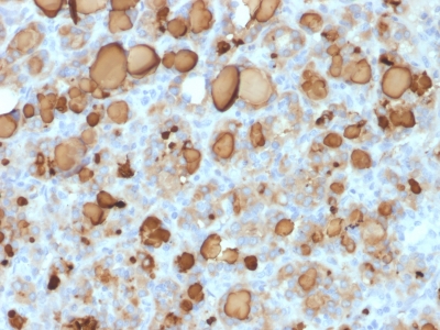 TG / Thyroglobulin Antibody - Formalin-paraffin human Thyroid Carcinoma stained with Thyroglobulin Mouse Recombinant Monoclonal Antibody (rTGB24).