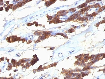 TG / Thyroglobulin Antibody - Formalin-fixed, paraffin-embedded human thyroid carcinoma stained with anti-Thyroglobulin antibody (SPM221).  This image was taken for the unmodified form of this product. Other forms have not been tested.