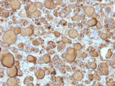 TG / Thyroglobulin Antibody - Formalin-paraffin human Thyroid Carcinoma stained with Thyroglobulin Rabbit Recombinant Monoclonal Antibody (TGB/1968R).