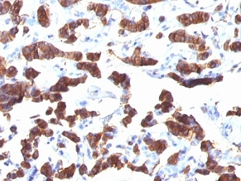 TG / Thyroglobulin Antibody - Formalin-fixed, paraffin-embedded human thyroid carcinoma stained with TG antibody (TGB24).  This image was taken for the unmodified form of this product. Other forms have not been tested.