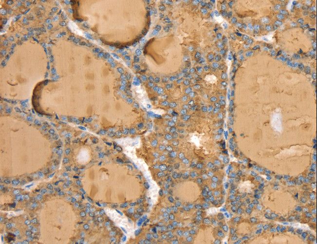 TG / Thyroglobulin Antibody - Immunohistochemistry of paraffin-embedded Human thyroid cancer using TG Polyclonal Antibody at dilution of 1:40.