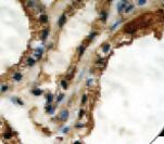 TG / Thyroglobulin Antibody - IHC of Thyroglobulin on FFPE Thyroid tissue. This image was taken for the unmodified form of this product. Other forms have not been tested.