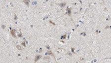 TG737 / IFT88 Antibody - 1:100 staining human brain carcinoma tissue by IHC-P. The sample was formaldehyde fixed and a heat mediated antigen retrieval step in citrate buffer was performed. The sample was then blocked and incubated with the antibody for 1.5 hours at 22°C. An HRP conjugated goat anti-rabbit antibody was used as the secondary.
