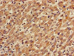 TGDS Antibody - Immunohistochemistry of paraffin-embedded human liver cancer using TGDS Antibody at dilution of 1:100
