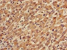 TGDS Antibody - Immunohistochemistry of paraffin-embedded human liver cancer using TGDS Antibody at dilution of 1:100