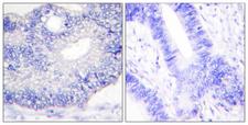 TGFA / TGF Alpha Antibody - Immunohistochemistry analysis of paraffin-embedded human colon carcinoma tissue, using TGF alpha Antibody. The picture on the right is blocked with the synthesized peptide.