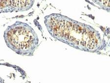 TGFA / TGF Alpha Antibody - Formalin-fixed, paraffin-embedded human testicular carcinoma stained with TGF-alpha antibody (P/T1).  This image was taken for the unmodified form of this product. Other forms have not been tested.