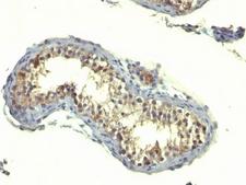 TGFA / TGF Alpha Antibody - Formalin-fixed, paraffin-embedded human testicular carcinoma stained with TGFa antibody (TG86).  This image was taken for the unmodified form of this product. Other forms have not been tested.