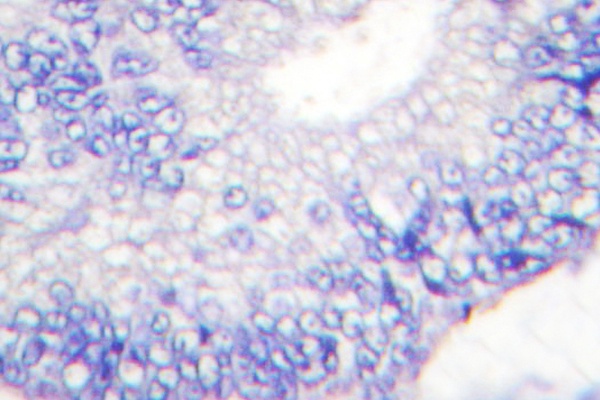 TGFA / TGF Alpha Antibody - IHC of TGF (R139) pAb in paraffin-embedded human colon carcinoma tissue.