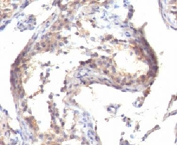 TGFA / TGF Alpha Antibody - IHC testing of FFPE human testicular carcinoma with TGF alpha antibody (clone MF9) This image was taken for the unmodified form of this product. Other forms have not been tested.