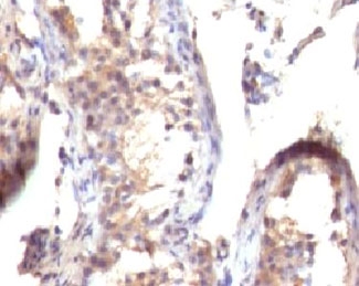 TGFA / TGF Alpha Antibody - IHC testing of FFPE human testicular carcinoma with TGF alpha antibody (clone TFGFa-1).  This image was taken for the unmodified form of this product. Other forms have not been tested.