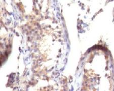 TGFA / TGF Alpha Antibody - IHC testing of FFPE human testicular carcinoma with TGF alpha antibody (clone TFGFa-1).  This image was taken for the unmodified form of this product. Other forms have not been tested.