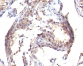 TGFA / TGF Alpha Antibody - Formalin-fixed, paraffin-embedded human testicular carcinoma stained with TGFa antibody (TGFA/1119).  This image was taken for the unmodified form of this product. Other forms have not been tested.