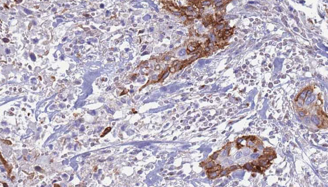 TGFA / TGF Alpha Antibody - 1:100 staining human urothelial carcinoma tissue by IHC-P. The sample was formaldehyde fixed and a heat mediated antigen retrieval step in citrate buffer was performed. The sample was then blocked and incubated with the antibody for 1.5 hours at 22°C. An HRP conjugated goat anti-rabbit antibody was used as the secondary.