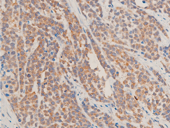 TGFB1 / TGF Beta 1 Antibody - 1:100 staining rat tumor tissue by IHC-P. The tissue was formaldehyde fixed and a heat mediated antigen retrieval step in citrate buffer was performed. The tissue was then blocked and incubated with the antibody for 1.5 hours at 22°C. An HRP conjugated goat anti-rabbit antibody was used as the secondary.